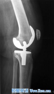 This x-ray shows shows an artificial knee joint, but now scientists are exploring regenerating damaged joints using a patient's own stem cells. This x-ray shows shows an artificial knee joint, but now scientists are exploring regenerating damaged joints using a patient's own stem cells.